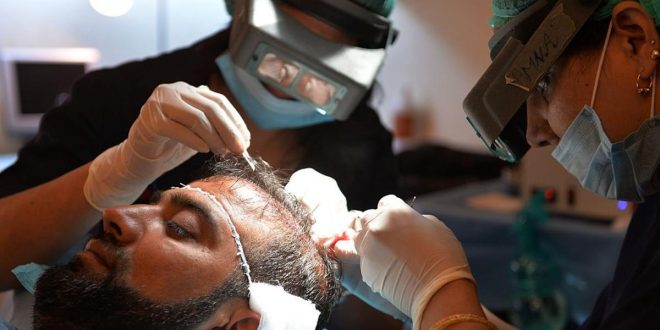 دراسة توضح “تأثير” زرع الشعر عند الرجال