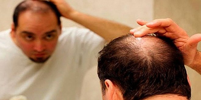 أسباب تؤدي إلى تساقط شعر الرأس