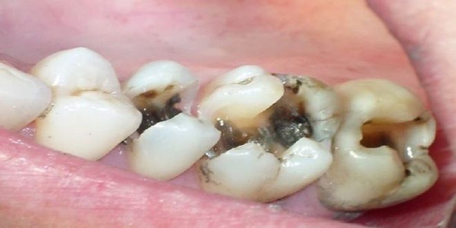 طريقة مذهلة ستخلصكم من تسوس الأسنان في 5 دقائق فقط